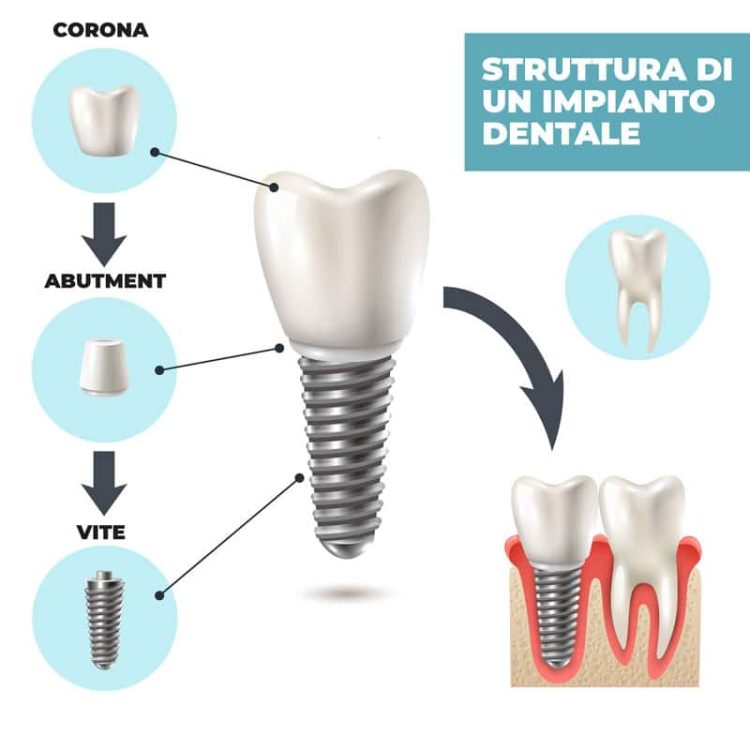 Immagine che mostra un impianto dentale in vista laterale, evidenziando la struttura e i componenti principali.