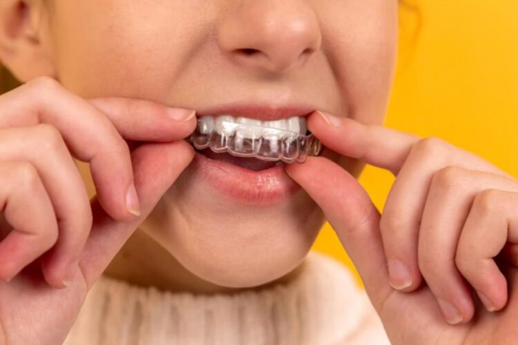 Allineatore ortodontico trasparente invisibile - Medical Dentist Roma
