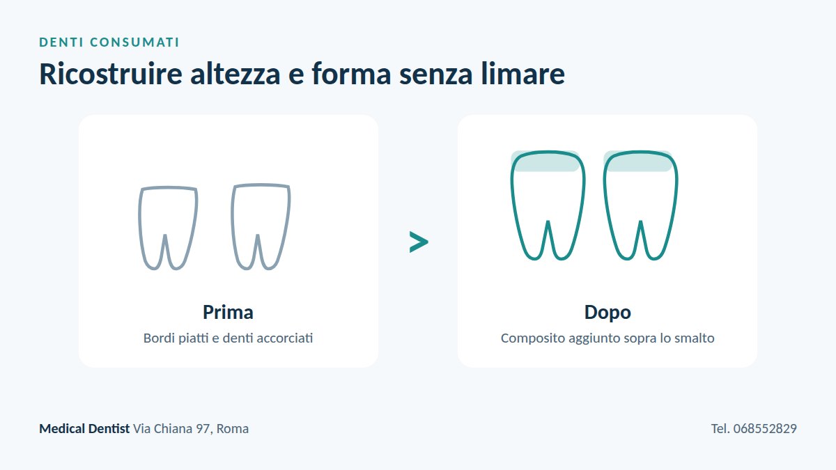 Denti consumati prima e dopo la ricostruzione con injection technique senza limare lo smalto